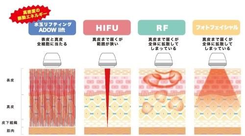 水玉リフティング|フェイスリフト - エステ美容商材卸販売 エステ